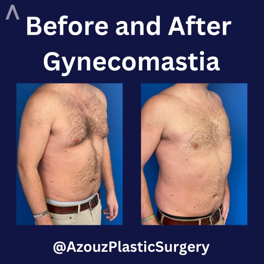 antes y después de la cirugía de eliminación de senos masculinos por el Dr. Azouz en Dallas, TX