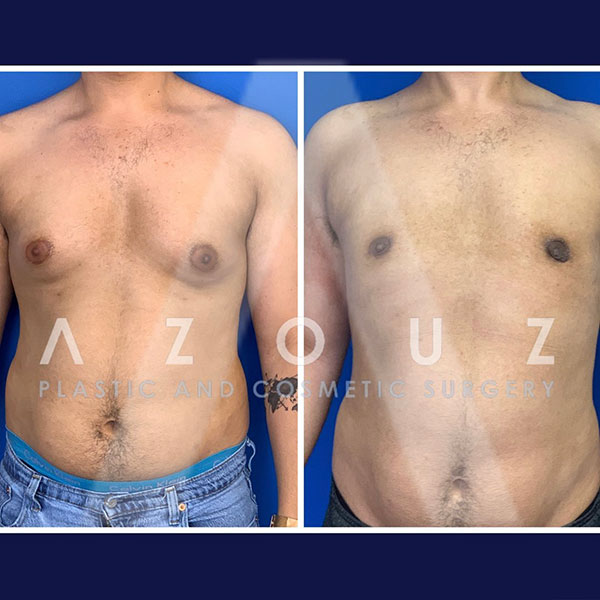 Antes y después de la cirugía de ginecomastia | Dr. Azouz | Instagram de Ginecomastia Dallas