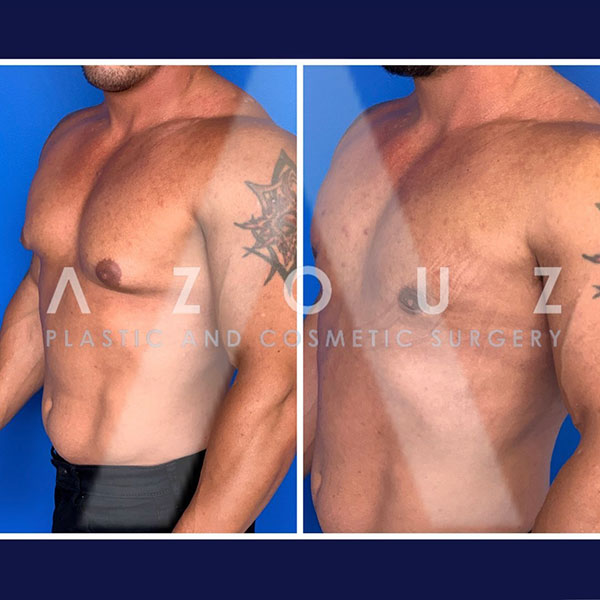 before and after gynecomastia surgery | Dr. Azouz | Dallas Gynecomastia Instagram