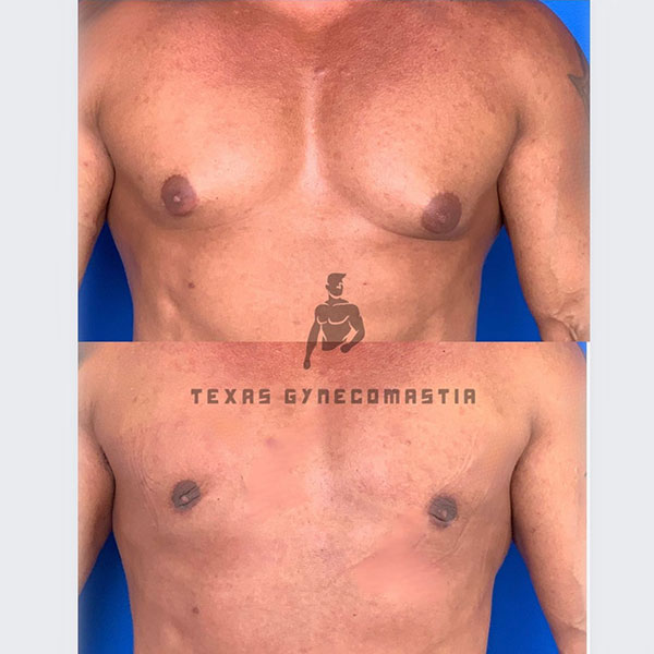 Antes y después de la cirugía de ginecomastia | Dr. Azouz | Instagram de Ginecomastia en Texas