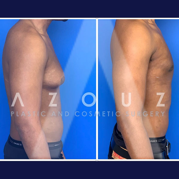 Antes y después de la cirugía de ginecomastia | Dr. Azouz | Instagram de Ginecomastia Dallas