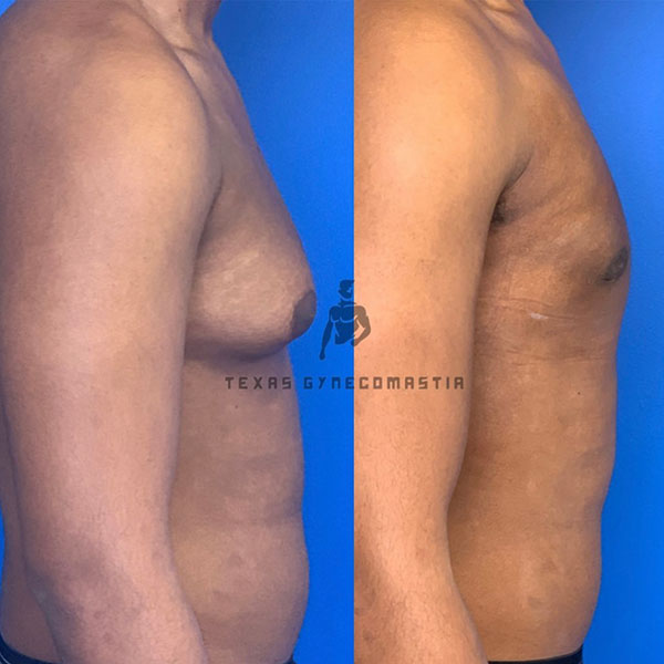 Antes y después de la cirugía de ginecomastia | Dr. Azouz | Instagram de Ginecomastia en Texas