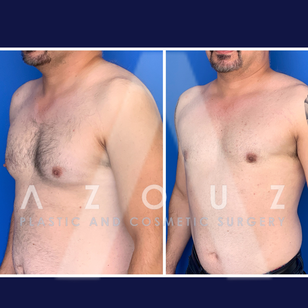 ginecomastia antes y después de la cirugía realizada por el cirujano plástico mejor calificado, el Dr. Azouz, en Dallas, TX