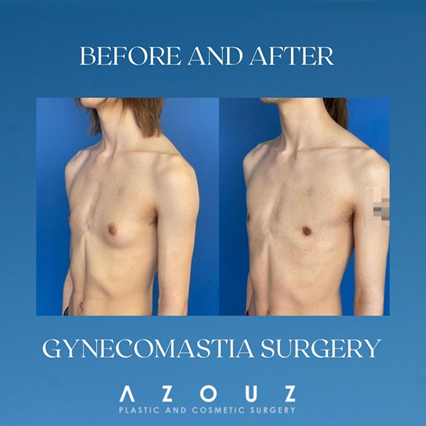 before and after gynecomastia surgery | Dr. Azouz | Texas Gynecomastia Instagram