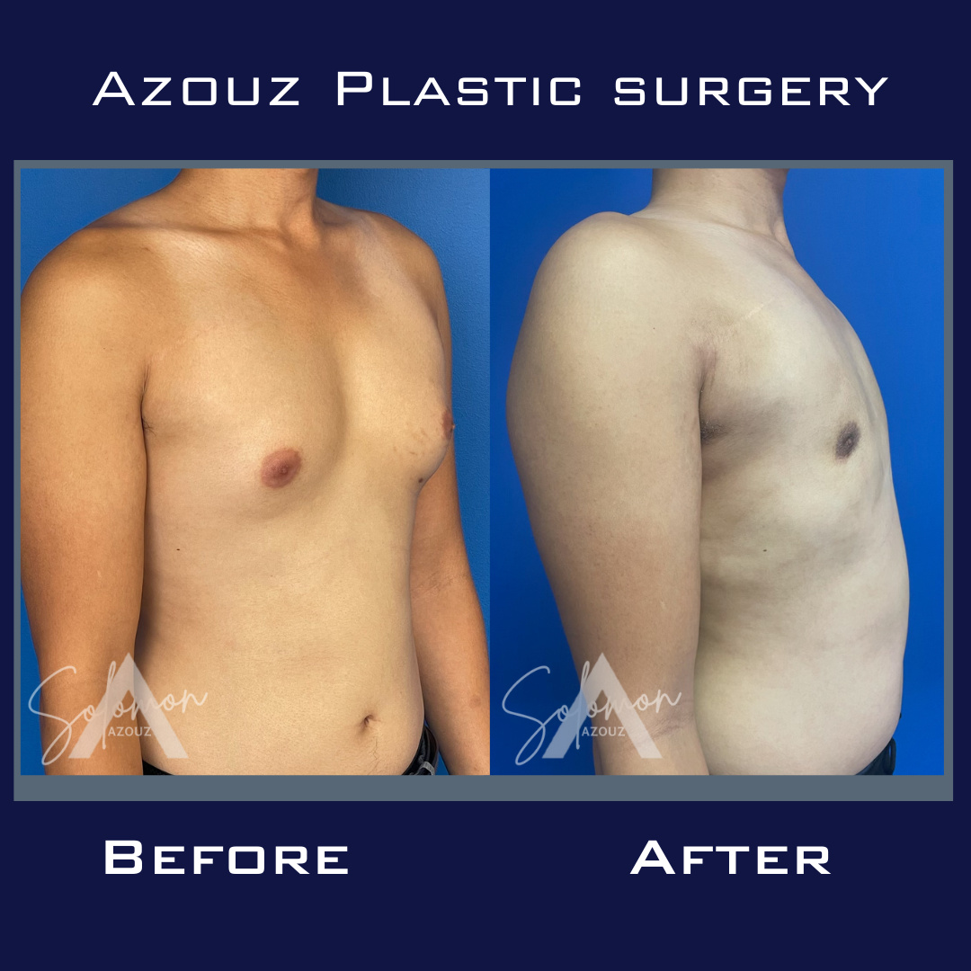 gynecomastia before and after surgery by top rated plastic surgeon Dr. Azouz in Dallas, TX