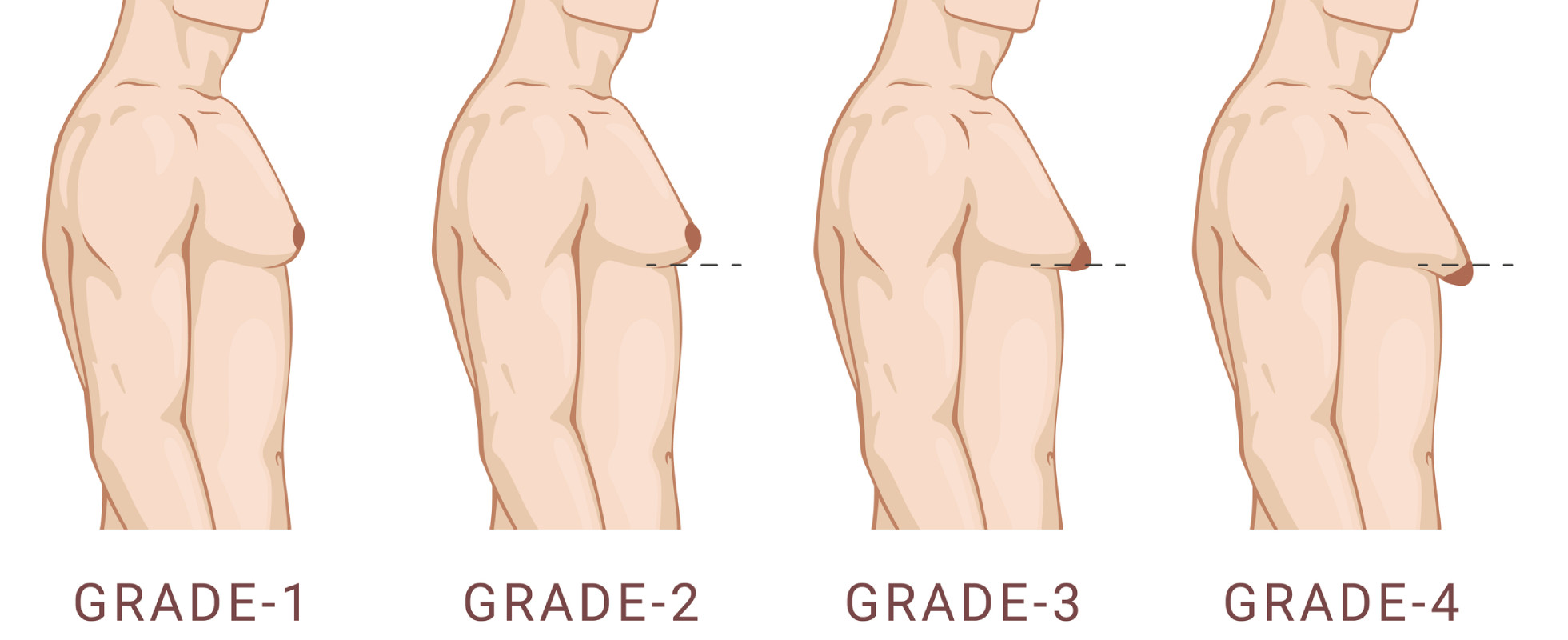 grades and stages of gynecomastia development
