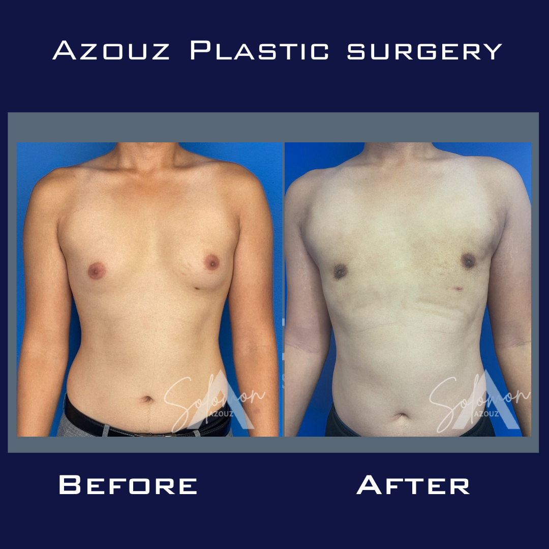 ginecomastia antes y después de la cirugía realizada por el cirujano plástico mejor calificado, el Dr. Azouz, en Dallas, TX