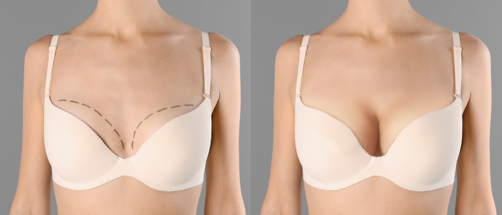 before and after breast aug with implants