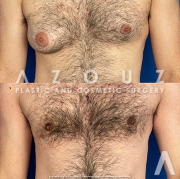 before and after gyno surgery in Dallas, TX by Dr. Azouz