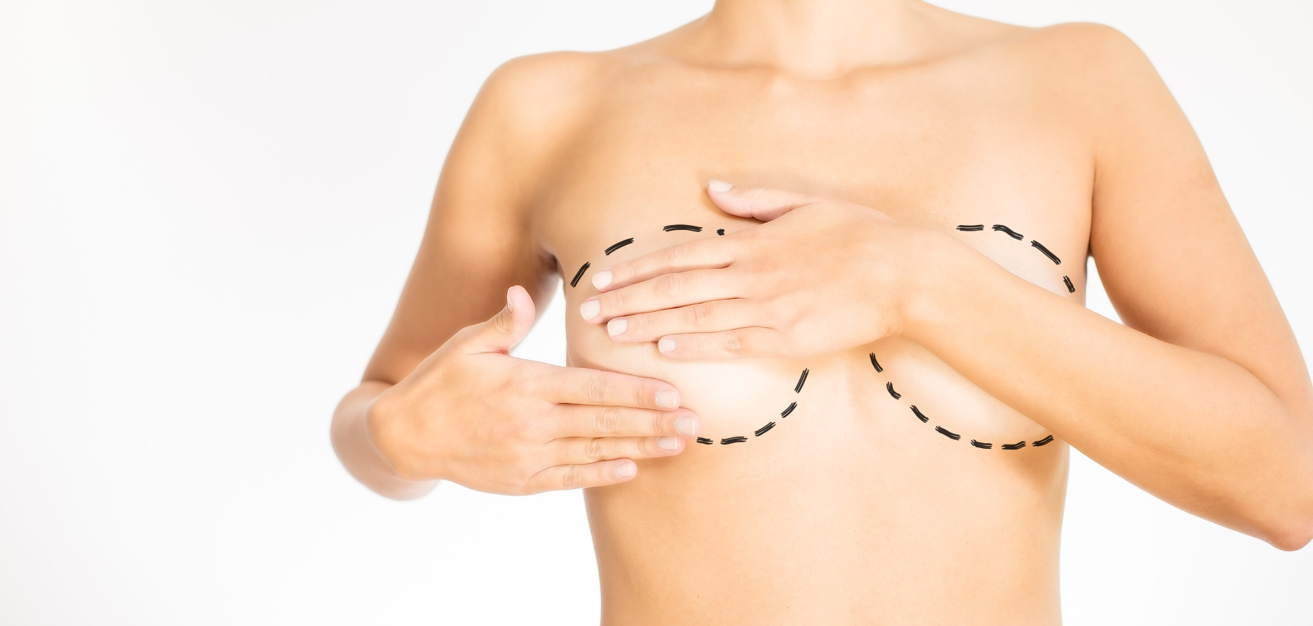 young woman concealing her breasts with her hands marked for plastic surgery