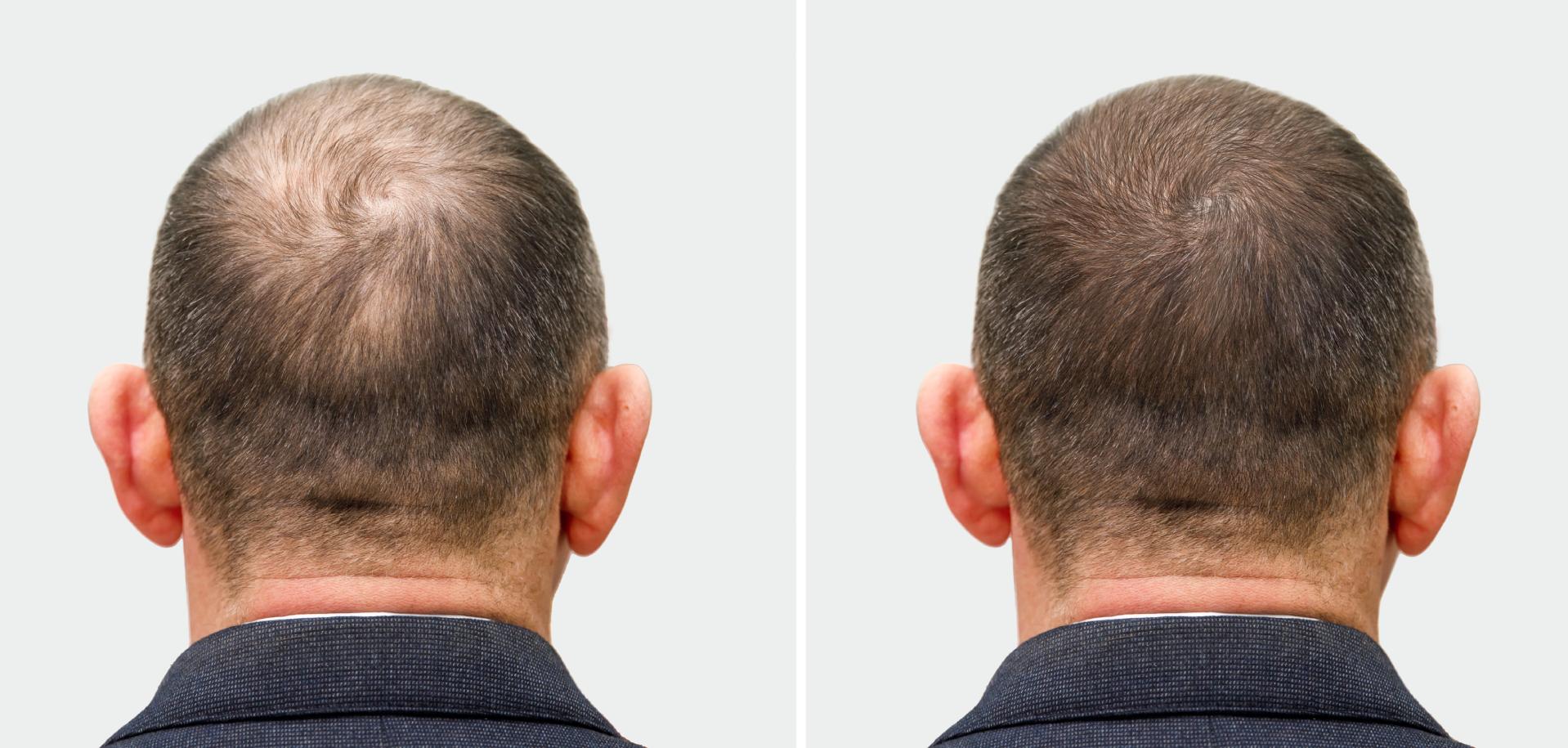 the head of a man before and after hair transplant surgery