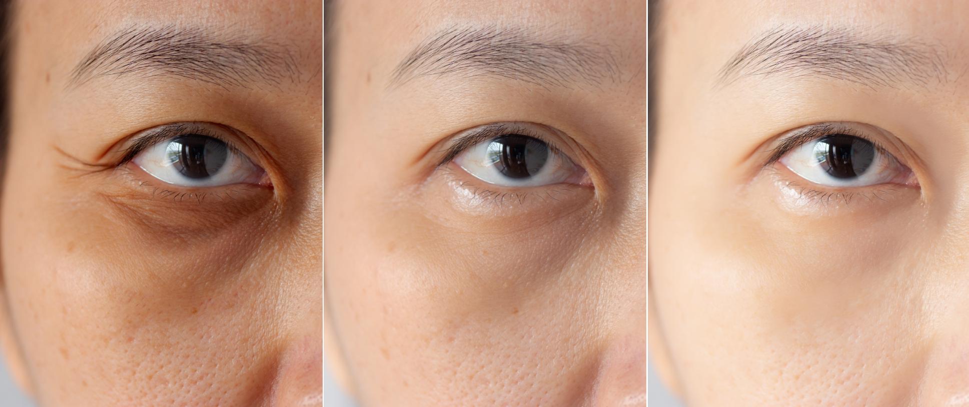 three pictures compared effect before and after treatment. under eyes with problems of dark circles