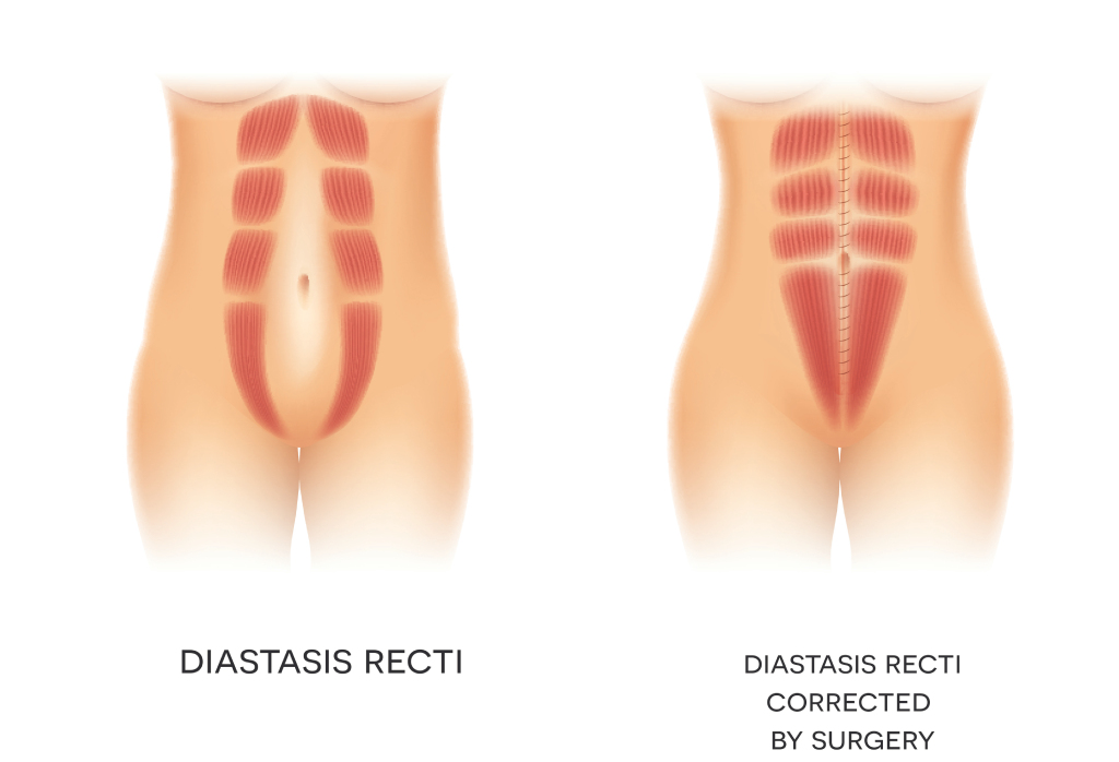 exercises after diastasis recti surgery