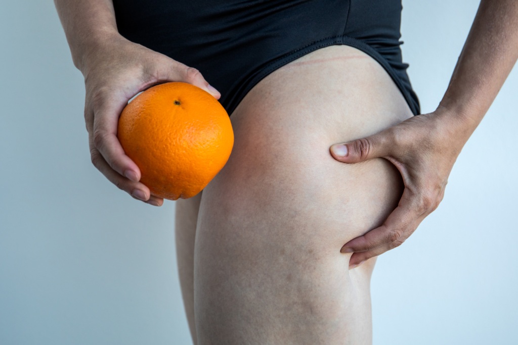 orange peel skin | cellulite treatment