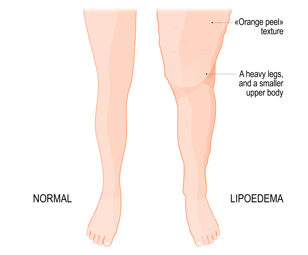 lipedema symptoms