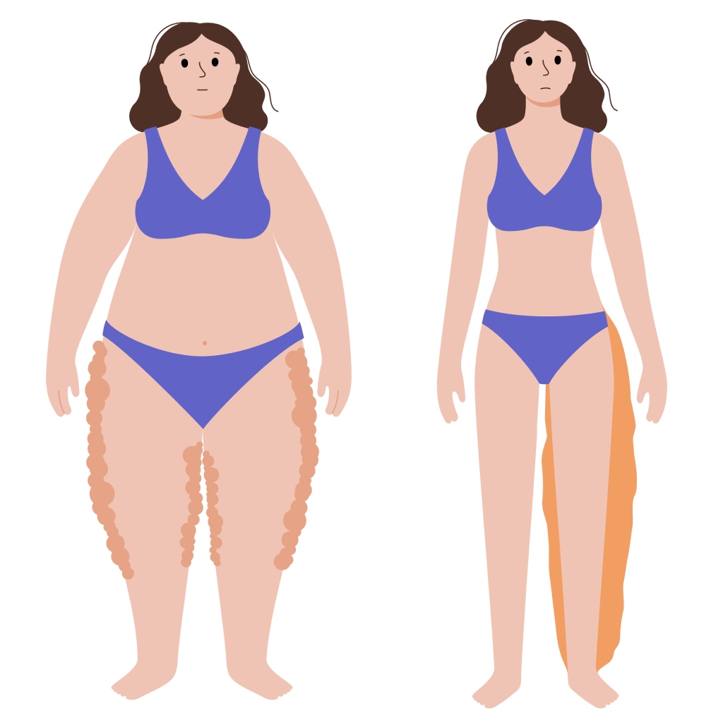 the difference between lipedema and lymphedema