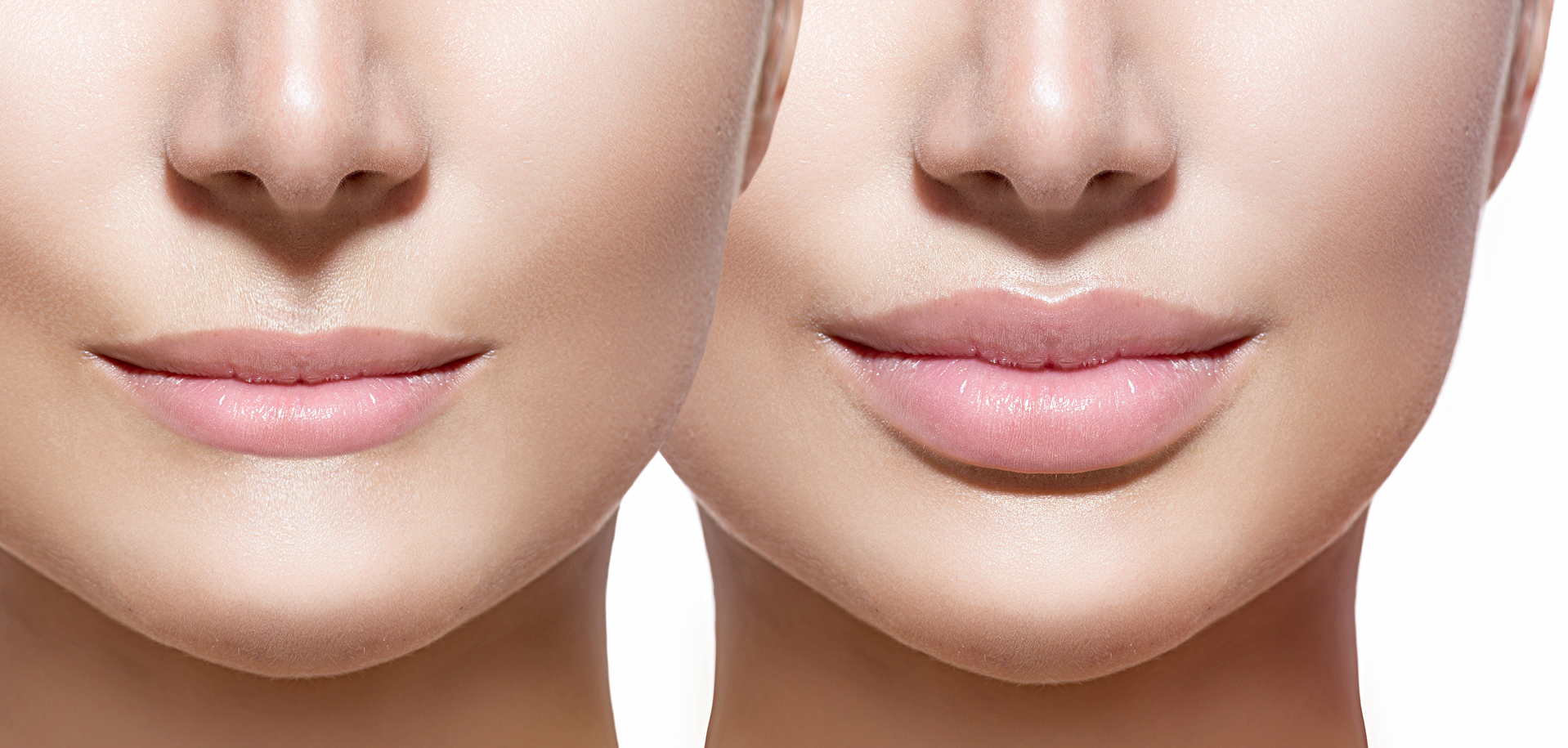 lips before and after lip filler