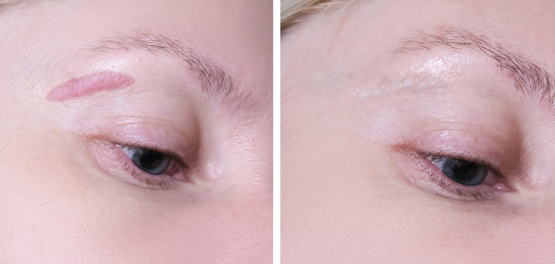 woman face before and after laser treatment
