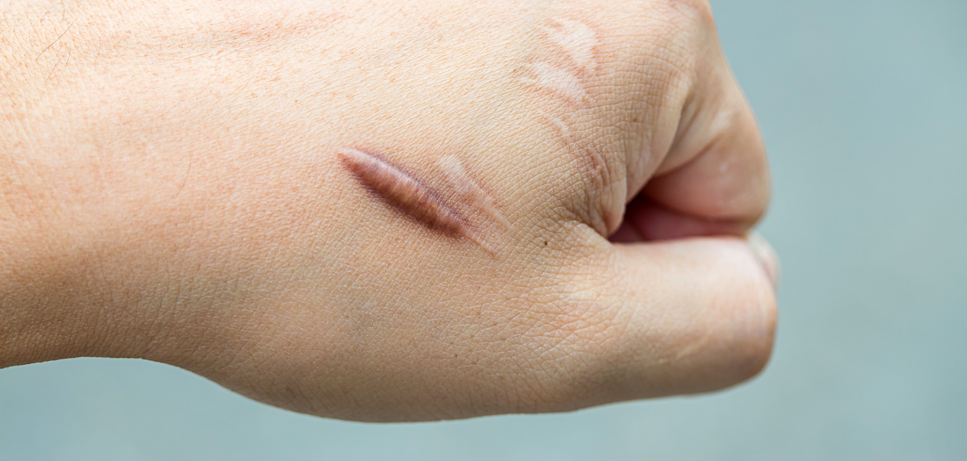 Keloid scar (Hypertrophic Scar) on man hand skin after accident