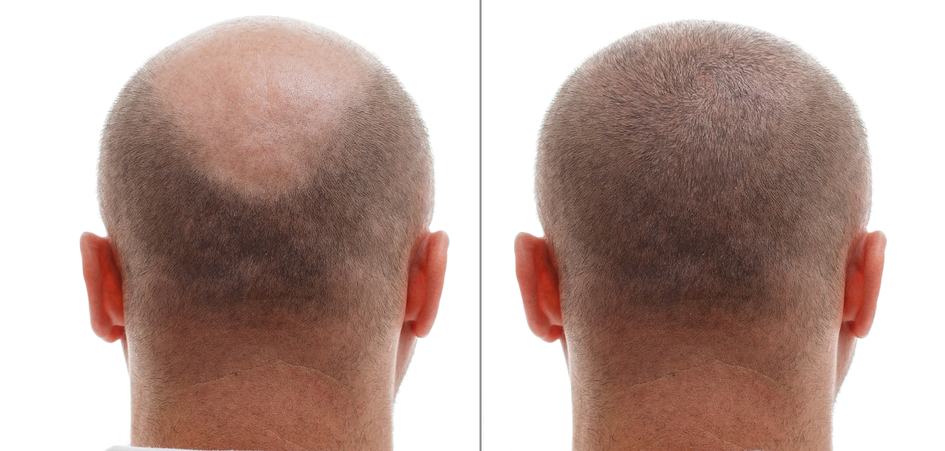 head before and after hair transfer