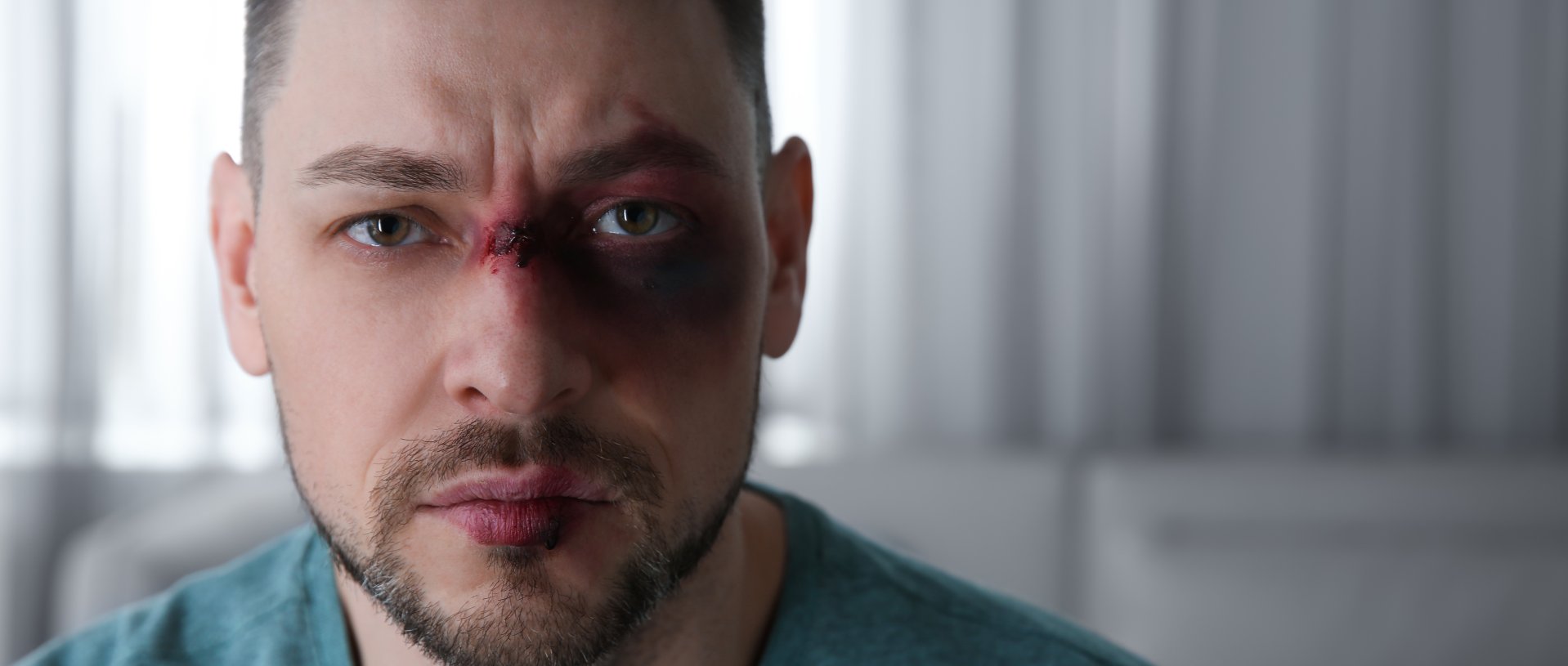 man with facial injuries | Facial Trauma Plastic Surgery