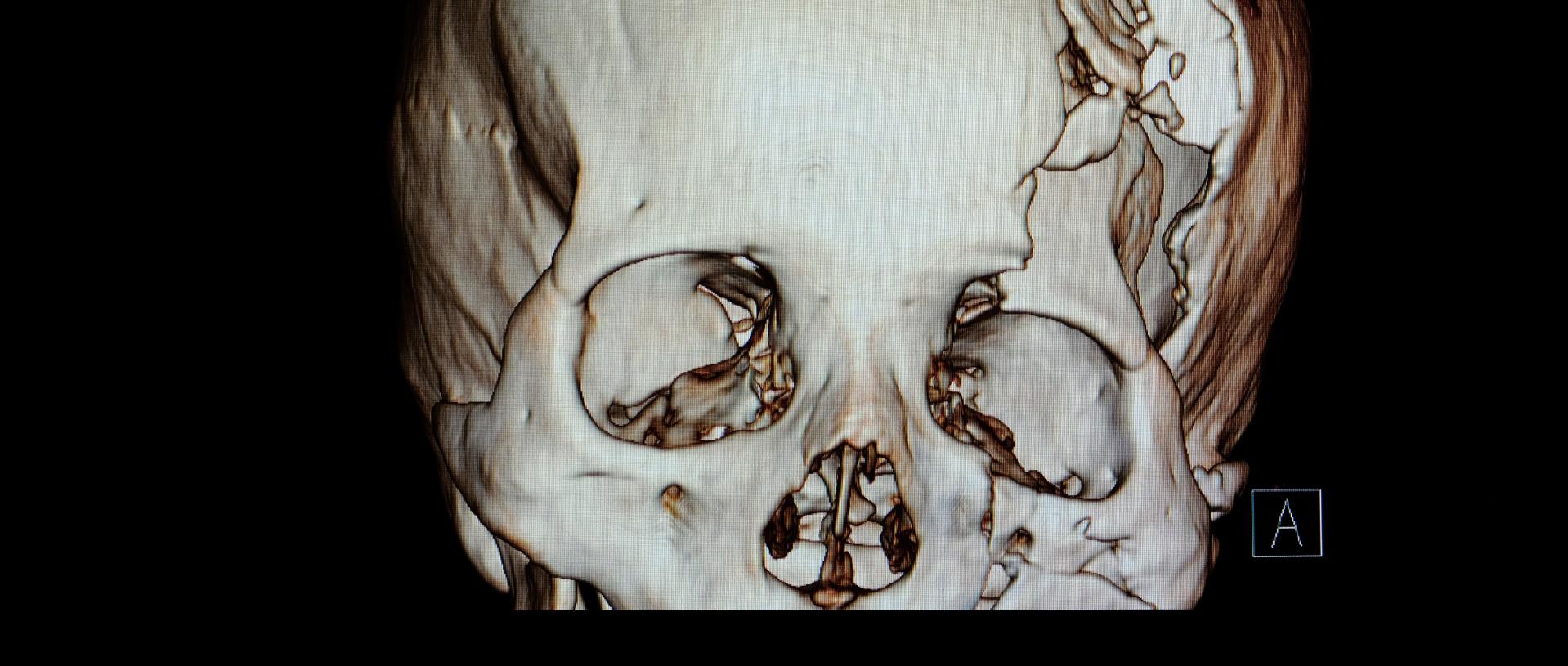 3-D rendering image showing compression fracture of left temperoparietal bone, fracture of left orbital rim and left zygomatic fracture | Orbital Fracture Repair