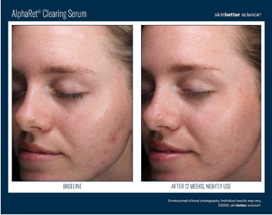 AlphaRet Clearing Serum | photo before and after 12 weeks, nightly use