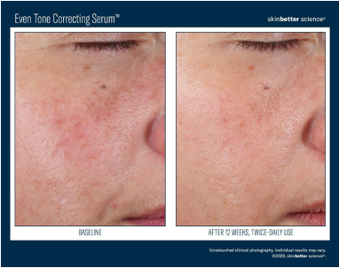 Even Tone Correcting Serum | photo before and after 12 weeks, twice-daily use