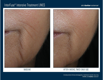 InterFuse® Intensive Treatment - Lines | photo before and after 4 weeks, twice-daily use