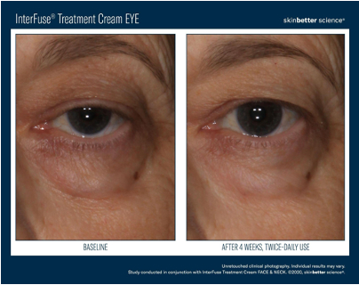 InterFuse® Treatment Cream - Eye | photo before and after 4 weeks, twice-daily use