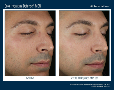 Solo Hydrating Defense™ Men | photo before and after 8 weeks, once-daily use