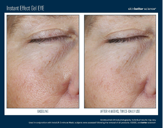 Instant Effect Gel Eye | photo before and after 4 weeks, twice-daily use