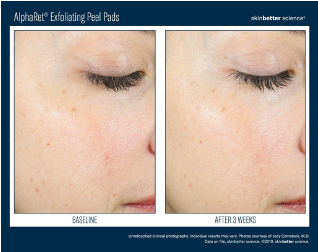 AlphaRet Exfoliating Peel Pads | photo before and after 3 weeks