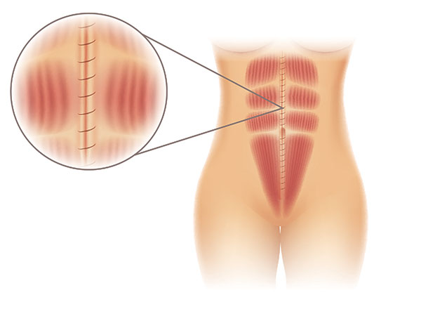 diastasis recti repair surgery
