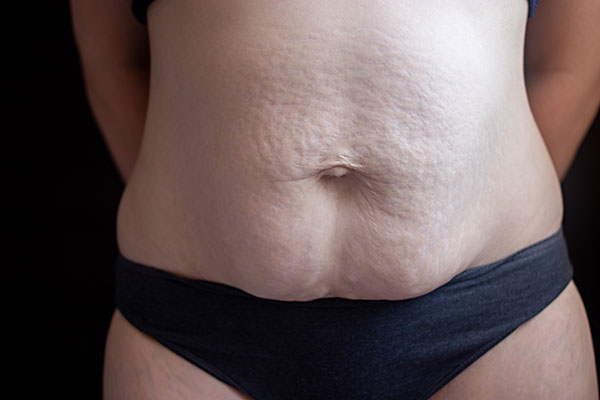 stomach muscle separation | diastasis recti pooch