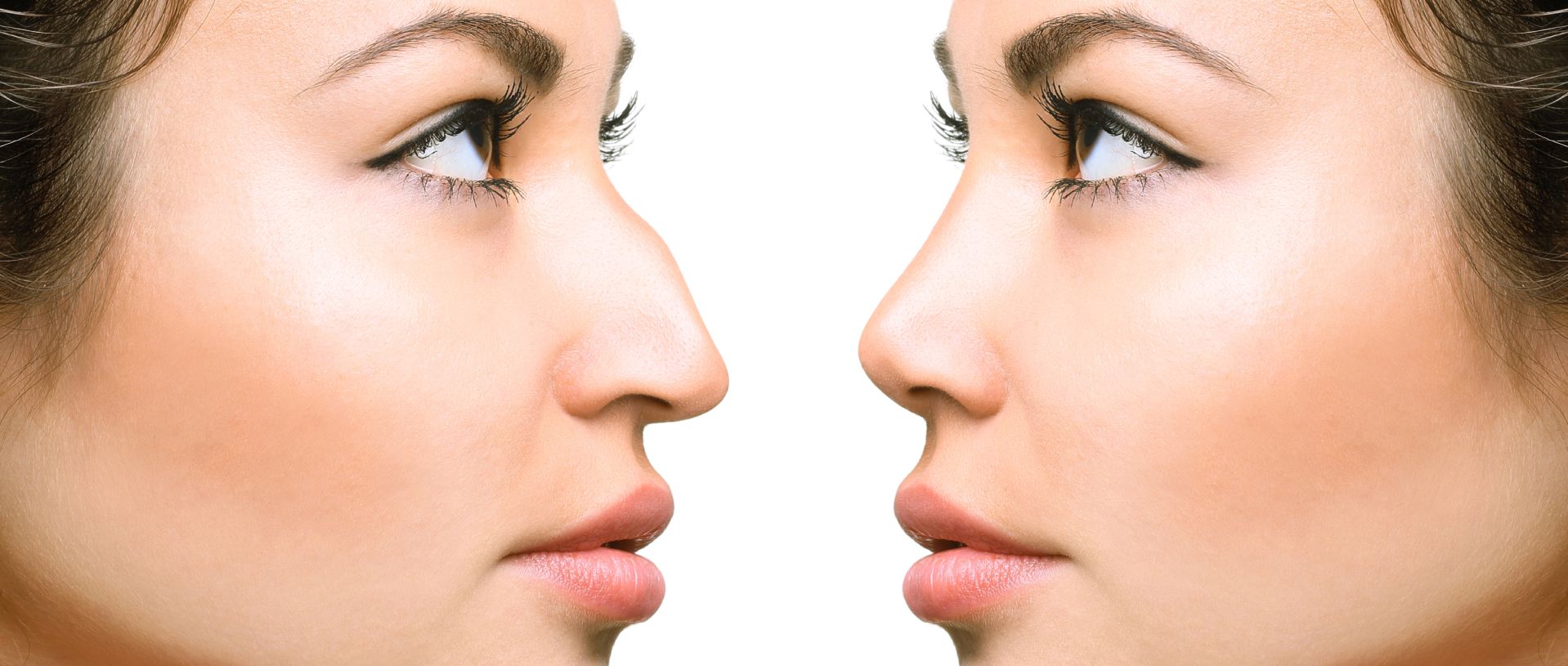 before and after rhinoplasty for Asians
