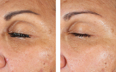 EyeMax AlphaRet Overnight | photo before and after use