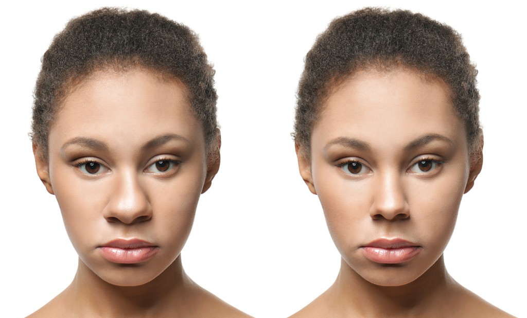 antes y después de rinoplastia | cirugía de nariz