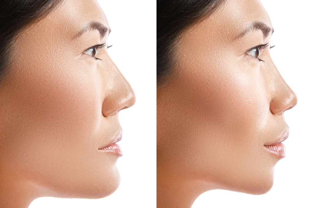 before and after ethnic rhinoplasty