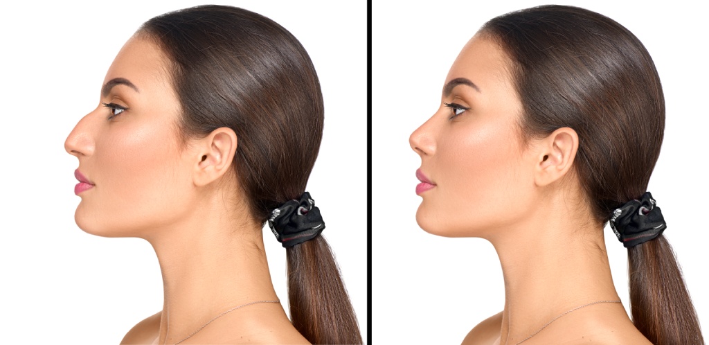 before and after ethnic rhinoplasty nose job