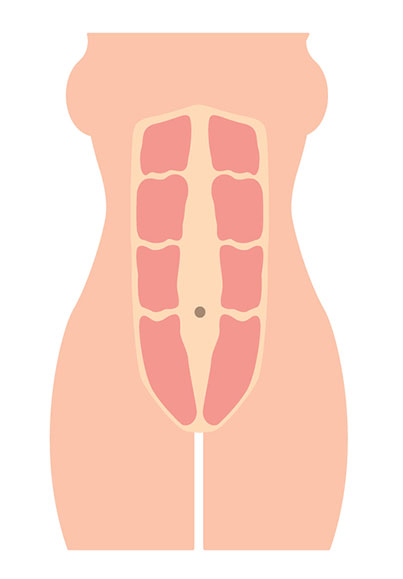 open diastasis