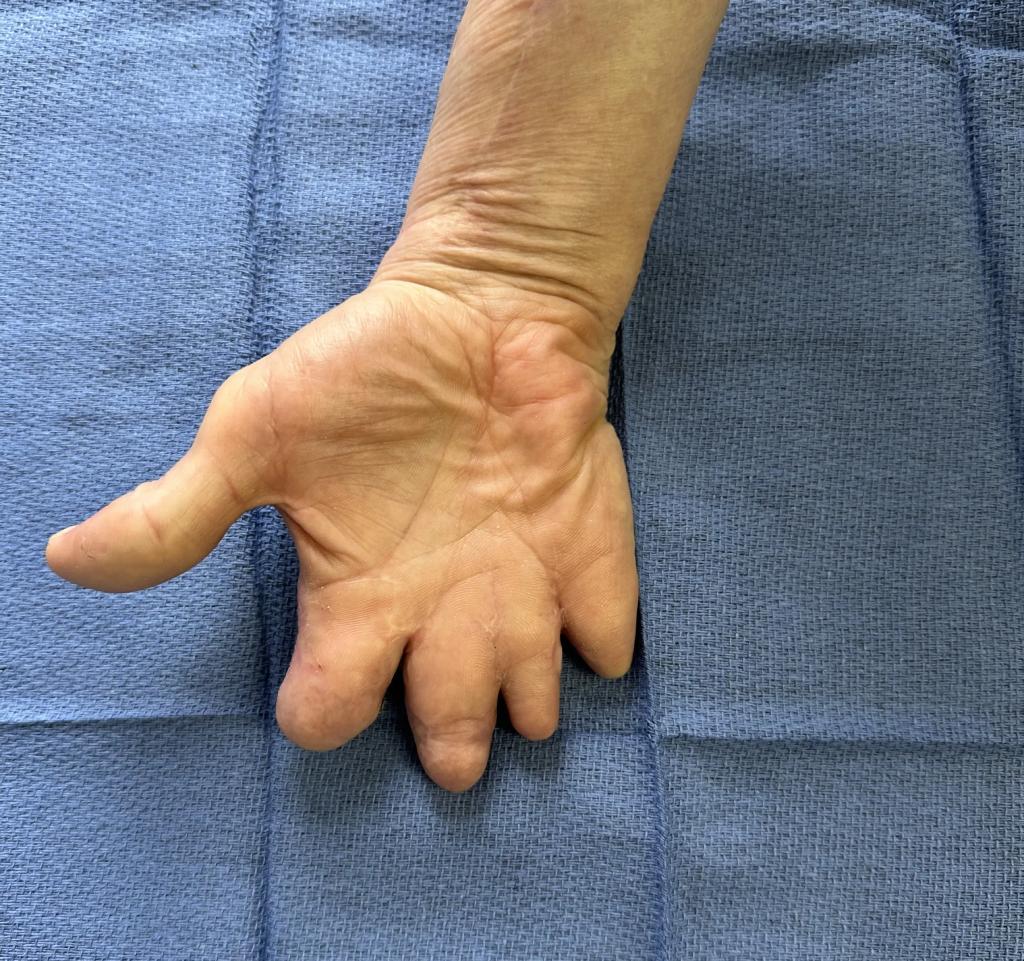 injerto de grasa en la mano antes y después por el Dr. Solomon Azouz en Dallas, TX