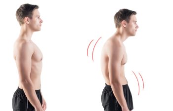 posture and gynecomastia