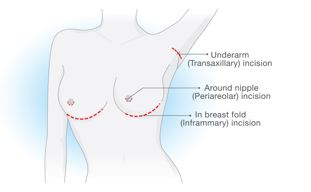 incisiones de cirugía de implantes mamarios | cicatrices de trabajo de senos
