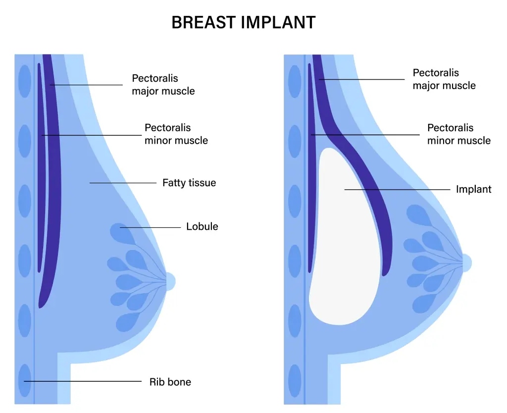 implante mamario antes y despues