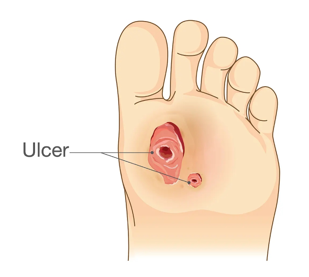 foot ulcer treatment | fat grafting to the feet