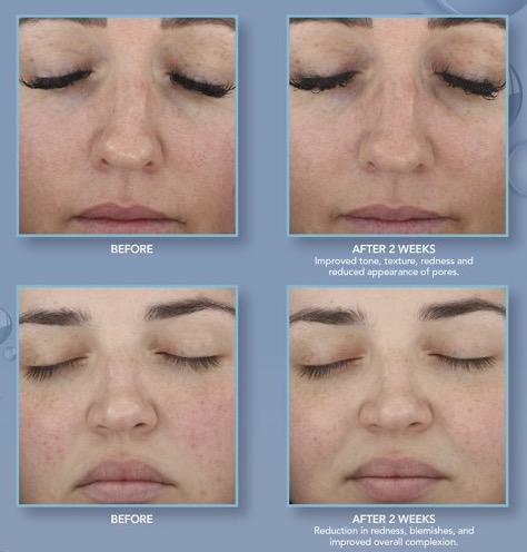 before and after Hydrinity renewing hyaluronic acid serum