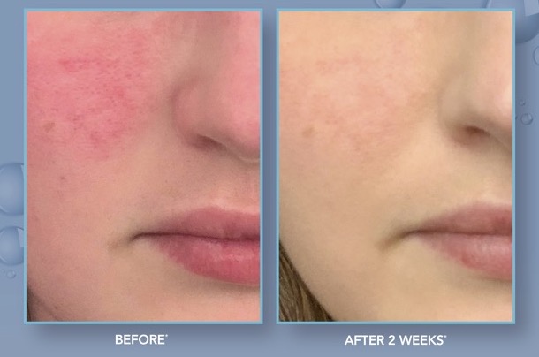 before and after Hydrinity restorative hyaluronic acid serum