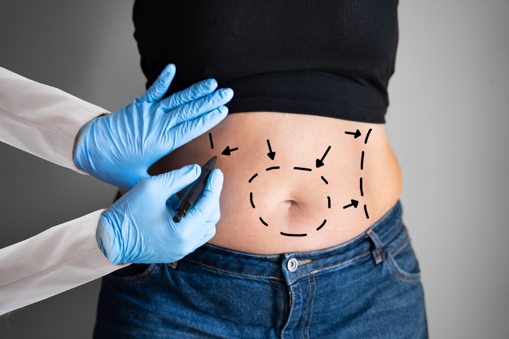 belly button after a tummy tuck