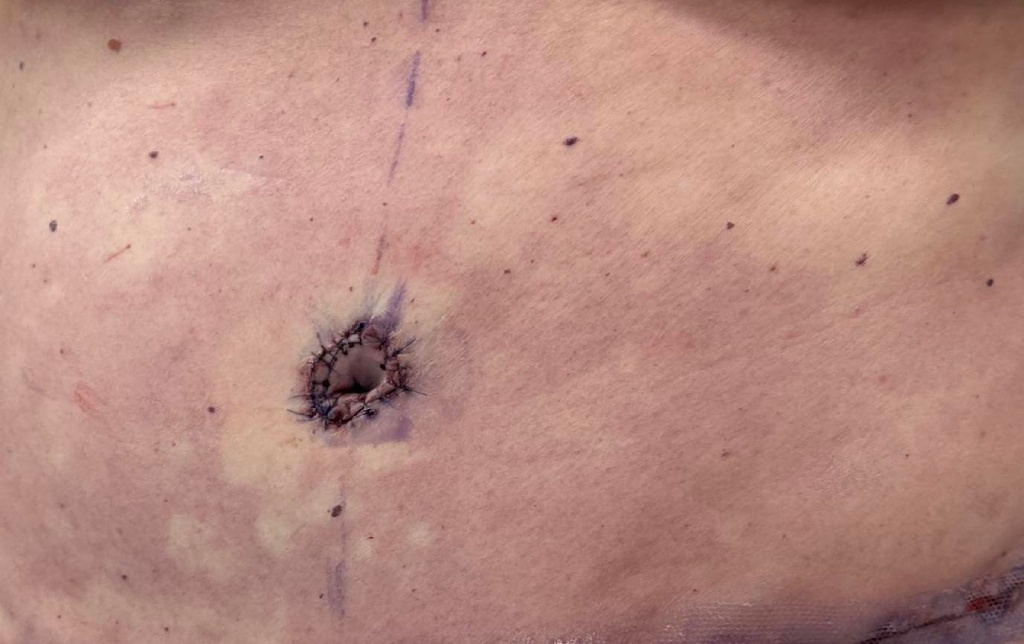 belly button after tummy tuck surgery by Dr. Solomon Azouz